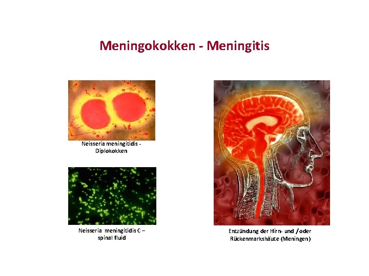 Meningokokken - Meningitis Neisseria meningitidis Diplokokken Neisseria meningitidis C – spinal fluid Entzündung der