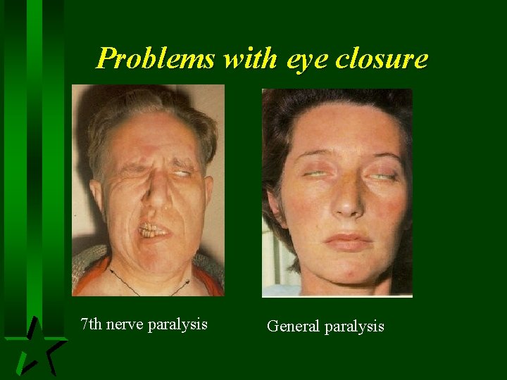 Problems with eye closure 7 th nerve paralysis General paralysis 