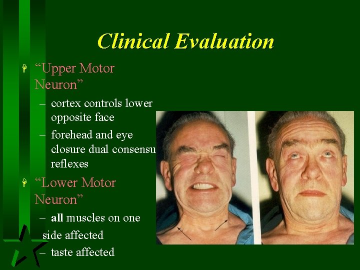 Clinical Evaluation H “Upper Motor Neuron” – cortex controls lower opposite face – forehead
