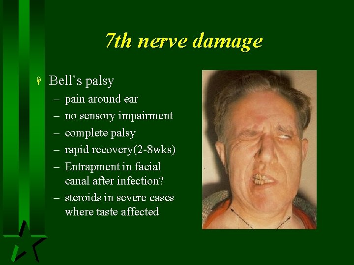 7 th nerve damage H Bell’s palsy – – – pain around ear no