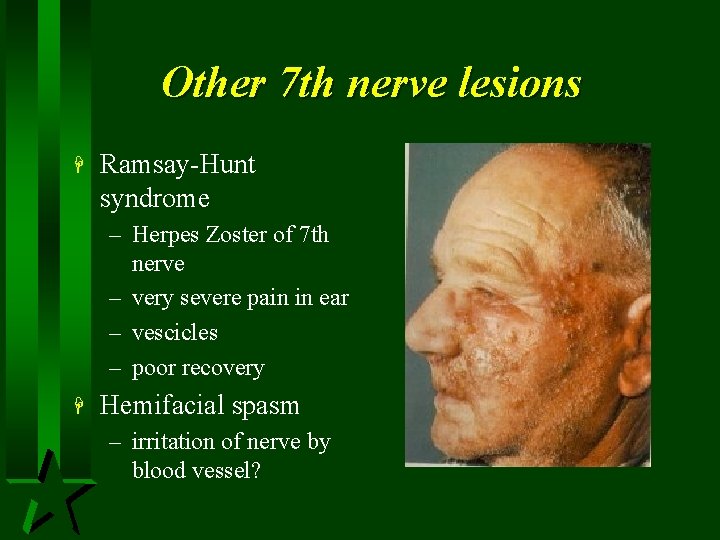 Other 7 th nerve lesions H Ramsay-Hunt syndrome – Herpes Zoster of 7 th