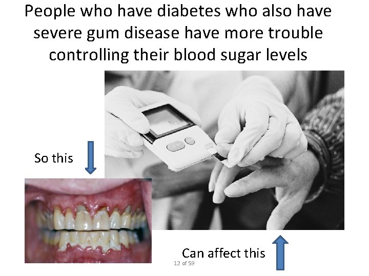 People who have diabetes who also have severe gum disease have more trouble controlling