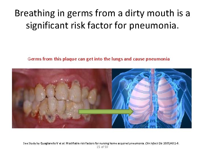 Breathing in germs from a dirty mouth is a significant risk factor for pneumonia.