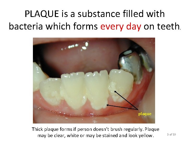 PLAQUE is a substance filled with bacteria which forms every day on teeth. plaque