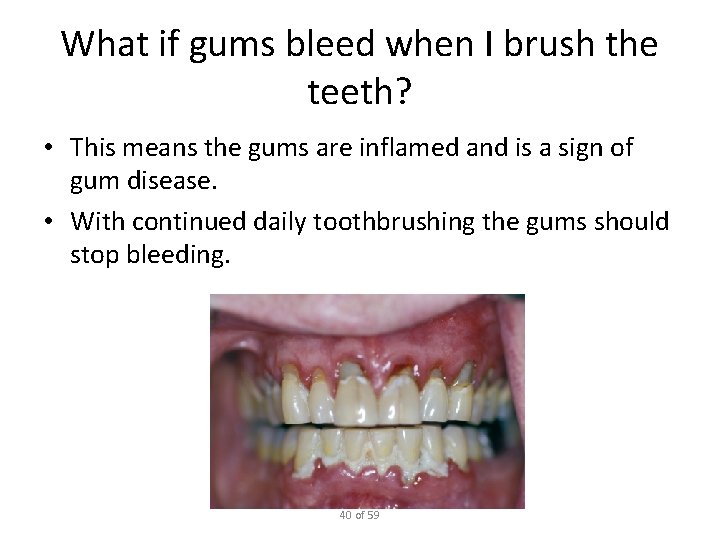 What if gums bleed when I brush the teeth? • This means the gums
