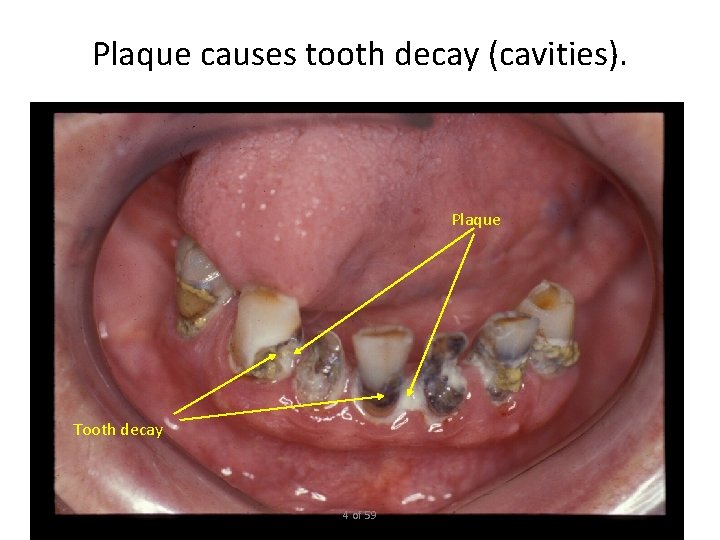 Plaque causes tooth decay (cavities). Plaque Tooth decay 4 of 59 