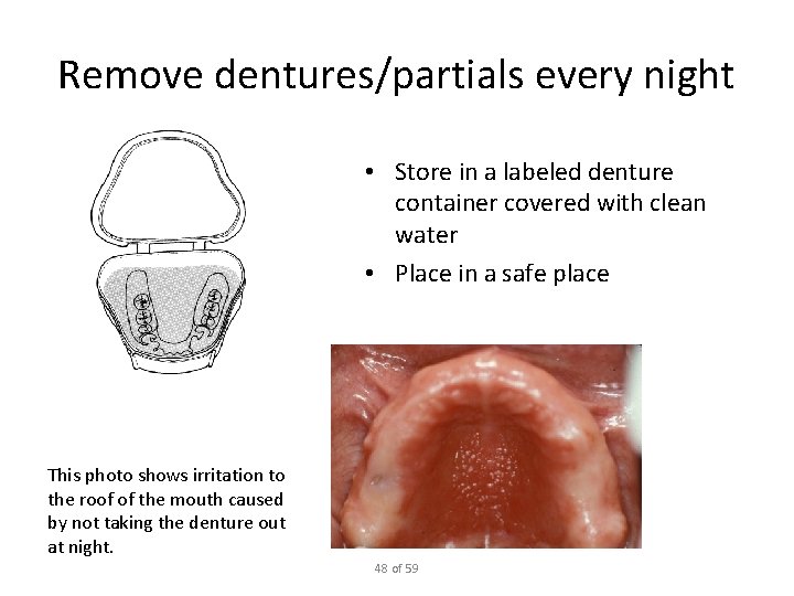 Remove dentures/partials every night • Store in a labeled denture container covered with clean