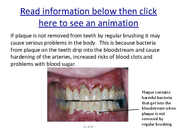 Read information below then click here to see an animation If plaque is not