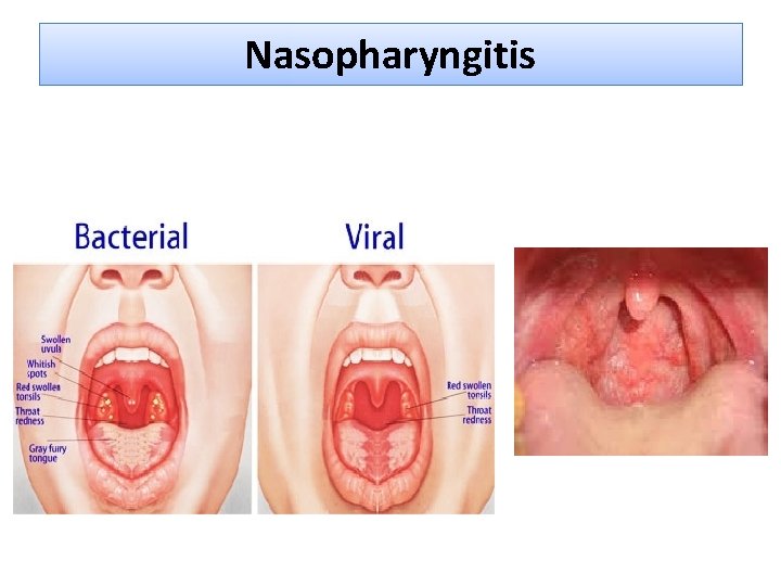 Nasopharyngitis 
