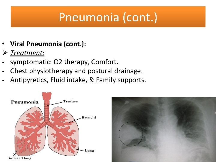 Pneumonia (cont. ) • Viral Pneumonia (cont. ): Ø Treatment: - symptomatic: O 2