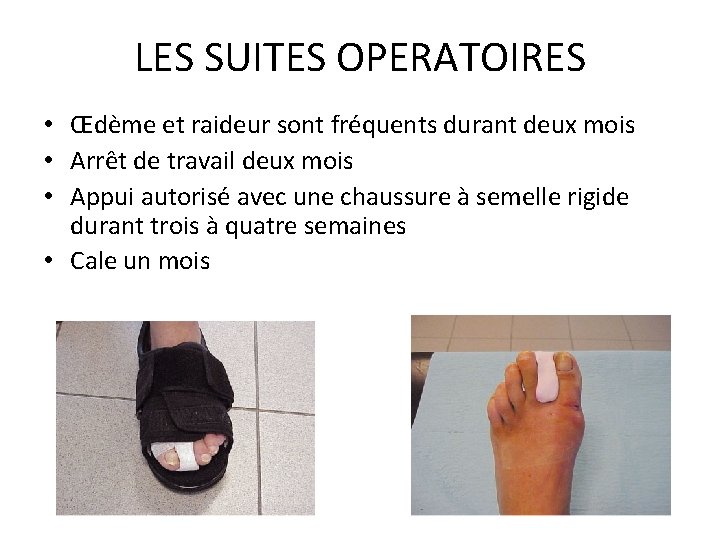 LES SUITES OPERATOIRES • Œdème et raideur sont fréquents durant deux mois • Arrêt