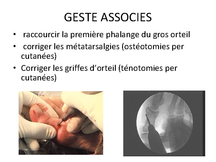 GESTE ASSOCIES • raccourcir la première phalange du gros orteil • corriger les métatarsalgies