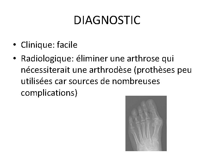 DIAGNOSTIC • Clinique: facile • Radiologique: éliminer une arthrose qui nécessiterait une arthrodèse (prothèses