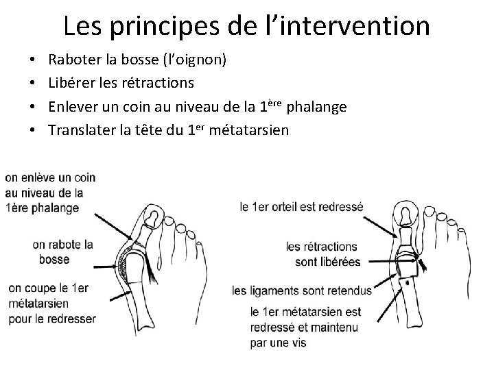 Les principes de l’intervention • • Raboter la bosse (l’oignon) Libérer les rétractions Enlever