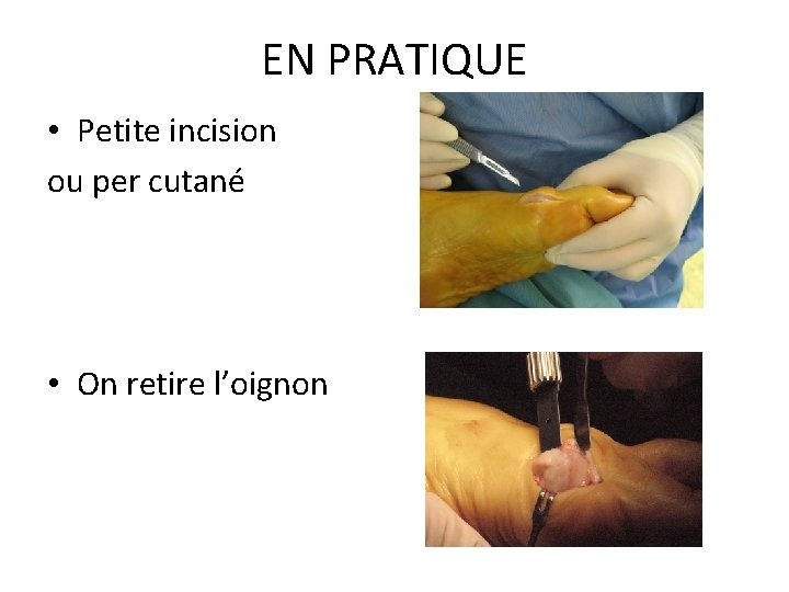 EN PRATIQUE • Petite incision ou per cutané • On retire l’oignon 