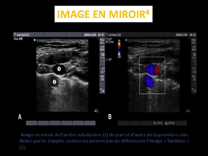 IMAGE EN MIROIR 4 Image en miroir de l’artère subclavière (1) de part et