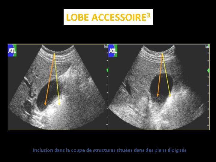 LOBE ACCESSOIRE 3 Inclusion dans la coupe de structures situées dans des plans éloignés