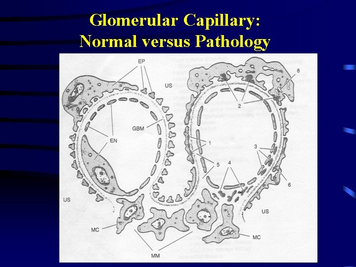 Glomerular Capillary: Normal versus Pathology 