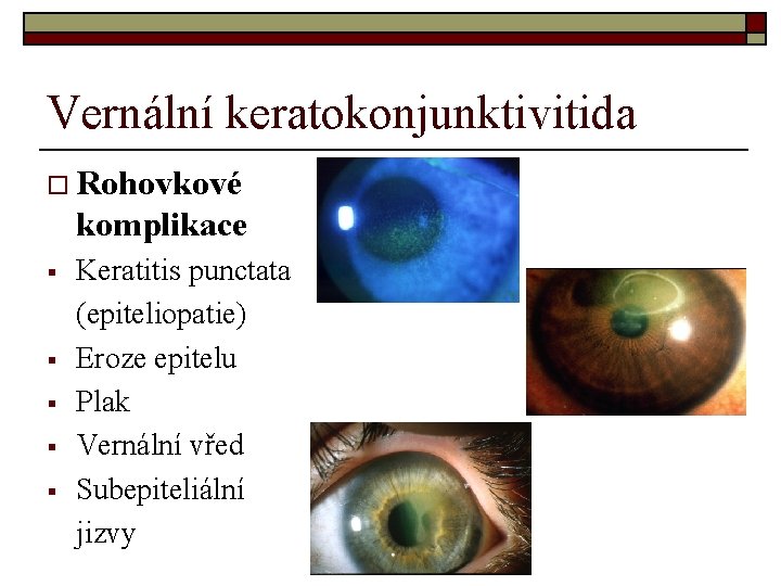 Vernální keratokonjunktivitida o Rohovkové komplikace § § § Keratitis punctata (epiteliopatie) Eroze epitelu Plak