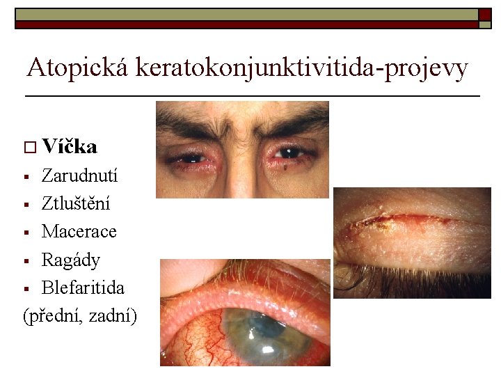 Atopická keratokonjunktivitida-projevy o Víčka Zarudnutí § Ztluštění § Macerace § Ragády § Blefaritida (přední,