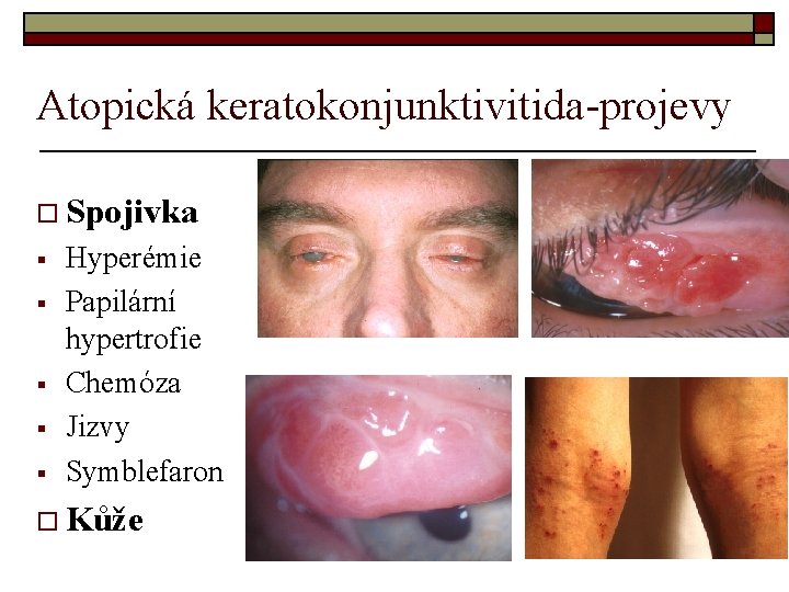 Atopická keratokonjunktivitida-projevy o Spojivka § § § Hyperémie Papilární hypertrofie Chemóza Jizvy Symblefaron o