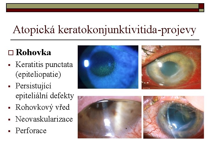 Atopická keratokonjunktivitida-projevy o Rohovka § § § Keratitis punctata (epiteliopatie) Persistující epiteliální defekty Rohovkový