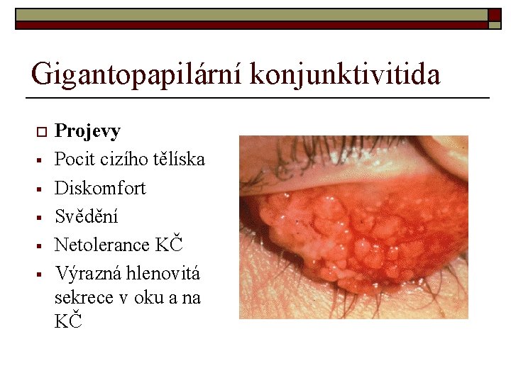 Gigantopapilární konjunktivitida o § § § Projevy Pocit cizího tělíska Diskomfort Svědění Netolerance KČ