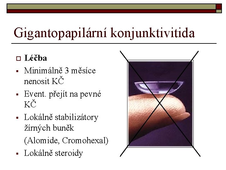 Gigantopapilární konjunktivitida o § § Léčba Minimálně 3 měsíce nenosit KČ Event. přejít na