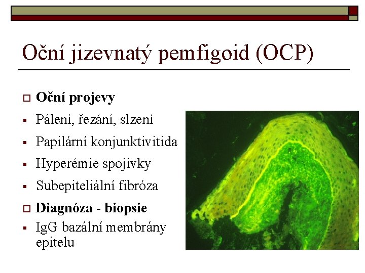 Oční jizevnatý pemfigoid (OCP) o Oční projevy § Pálení, řezání, slzení § Papilární konjunktivitida