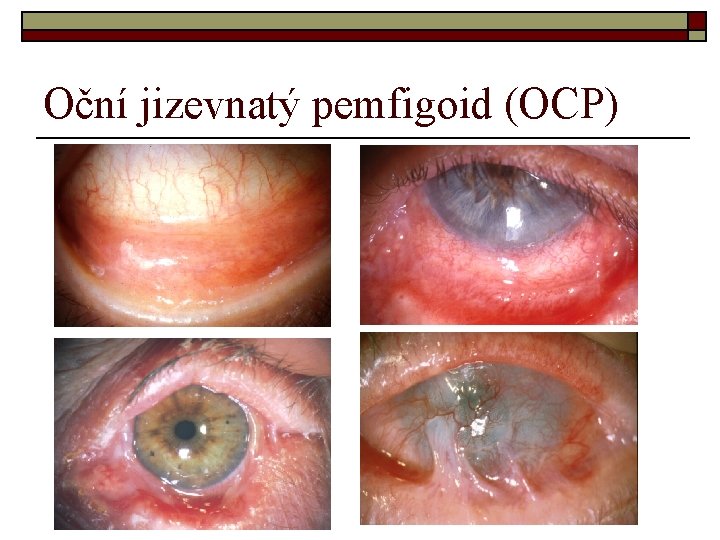 Oční jizevnatý pemfigoid (OCP) 