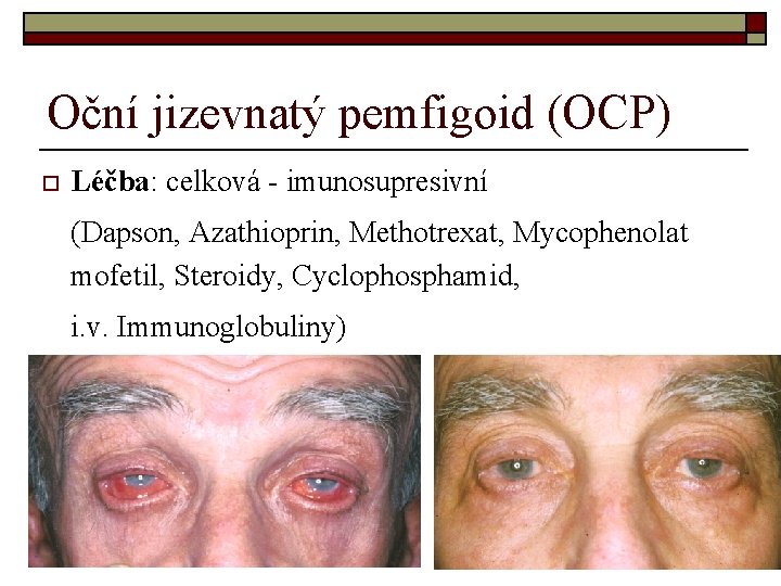 Oční jizevnatý pemfigoid (OCP) o Léčba: celková - imunosupresivní (Dapson, Azathioprin, Methotrexat, Mycophenolat mofetil,
