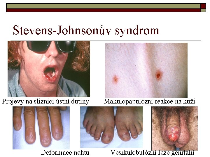 Stevens-Johnsonův syndrom Projevy na sliznici ústní dutiny Makulopapulózní reakce na kůži Deformace nehtů Vesikulobulózní