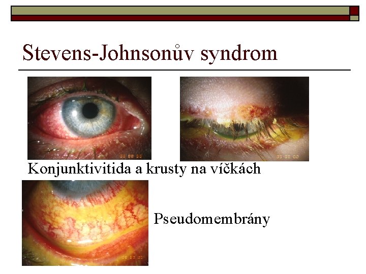 Stevens-Johnsonův syndrom Konjunktivitida a krusty na víčkách Pseudomembrány 