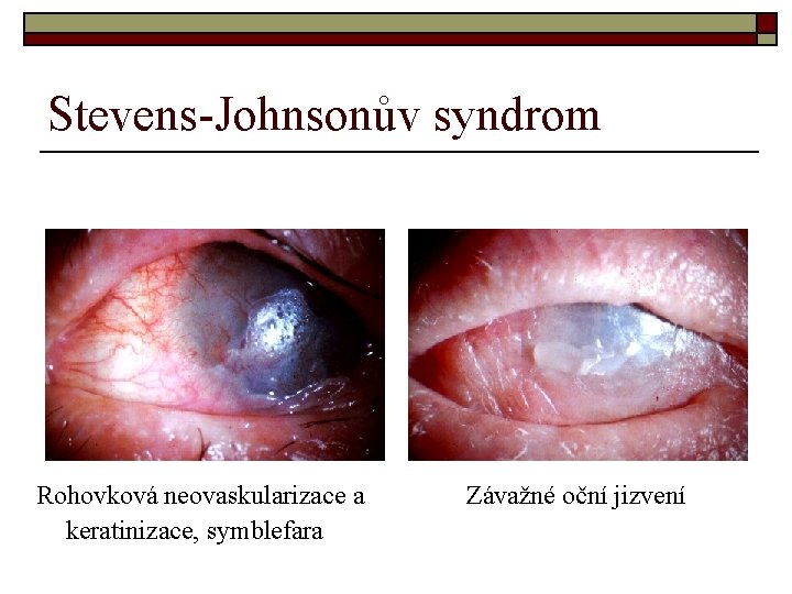 Stevens-Johnsonův syndrom Rohovková neovaskularizace a keratinizace, symblefara Závažné oční jizvení 