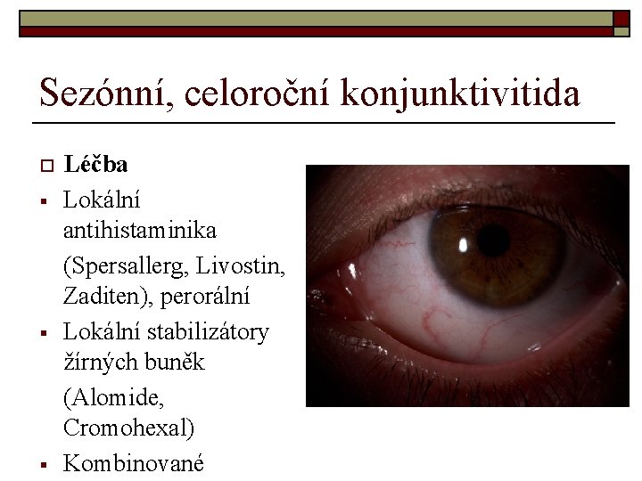 Sezónní, celoroční konjunktivitida o § § § Léčba Lokální antihistaminika (Spersallerg, Livostin, Zaditen), perorální