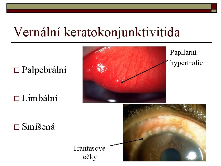 Vernální keratokonjunktivitida Papilární hypertrofie o Palpebrální o Limbální o Smíšená Trantasové tečky 