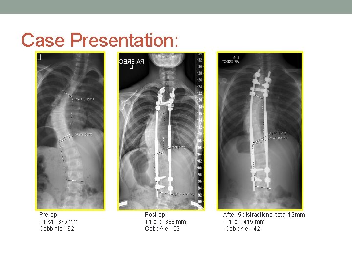 Case Presentation: Pre-op T 1 -s 1: 375 mm Cobb ^le - 62 Post-op