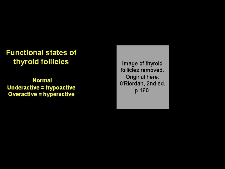 Normal Functional states of thyroid follicles Normal Underactive = hypoactive Overactive = hyperactive Image