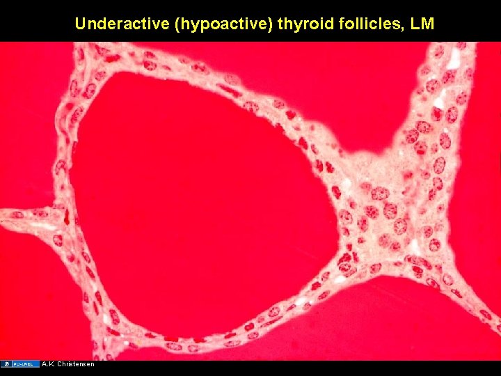 Underactive (hypoactive) thyroid follicles, LM A. K. Christensen 