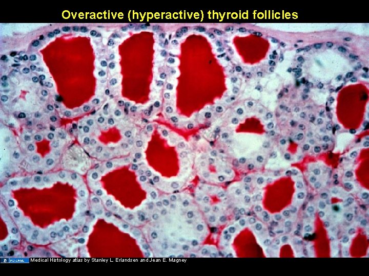 Overactive (hyperactive) thyroid follicles Medical Histology atlas by Stanley L. Erlandsen and Jean E.