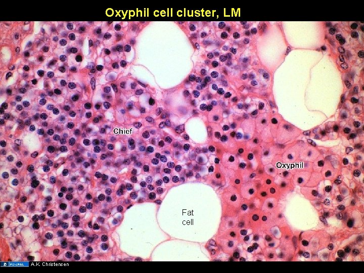 Oxyphil cell cluster, LM Fat cell A. K. Christensen 