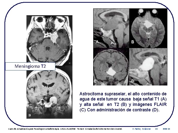 Meningioma T 2 Astrocitoma supraselar, el alto contenido de agua de este tumor causa