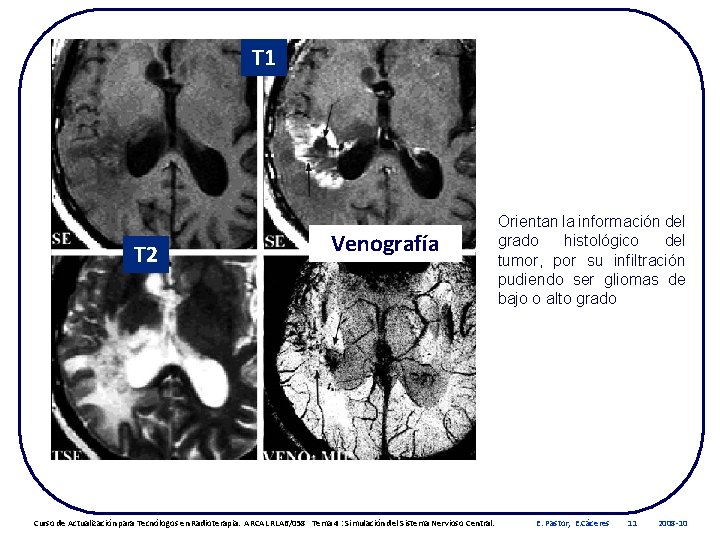 T 1 T 2 Venografía Curso de Actualización para Tecnólogos en Radioterapia. ARCAL RLA