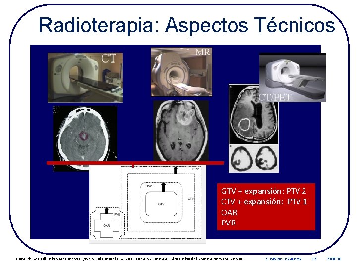 Radioterapia: Aspectos Técnicos GTV + expansión: PTV 2 CTV + expansión: PTV 1 OAR