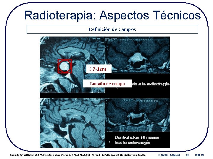 Radioterapia: Aspectos Técnicos Definición de Campos 0. 7 -1 cm Tamaño de campo Curso