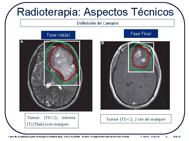 Radioterapia: Aspectos Técnicos Definición de Campos Fase Final Fase Inicial Tumor (T 1+C); edema