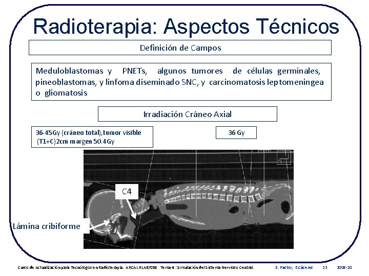 Radioterapia: Aspectos Técnicos Definición de Campos Meduloblastomas y PNETs, algunos tumores de células germinales,