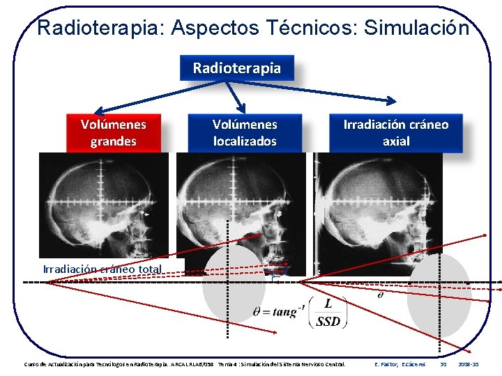 Radioterapia: Aspectos Técnicos: Simulación Radioterapia Volúmenes grandes Irradiación cráneo total Volúmenes localizados . .