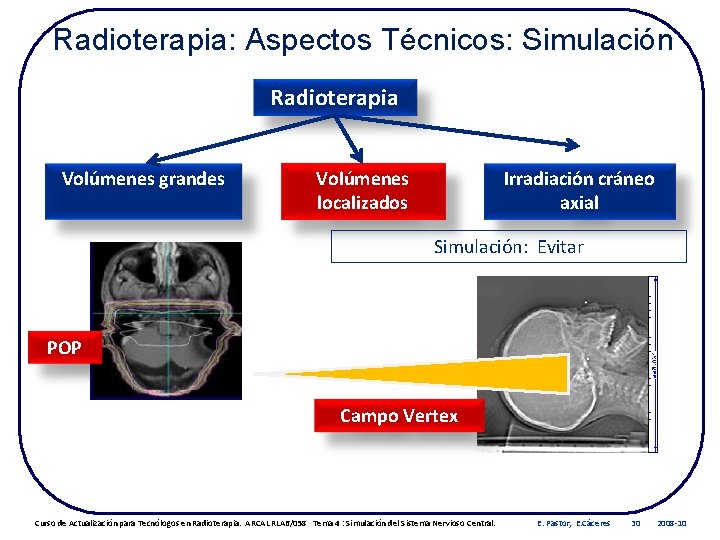 Radioterapia: Aspectos Técnicos: Simulación Radioterapia Volúmenes grandes Volúmenes localizados Irradiación cráneo axial Simulación: Evitar