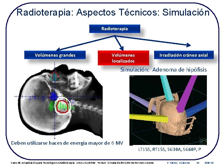 Radioterapia: Aspectos Técnicos: Simulación Radioterapia Volúmenes grandes Volúmenes localizados Irradiación cráneo axial Simulación: Adenoma